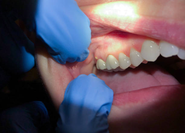 Best Tooth Infection Emergency Dentist  in Frisco, TX